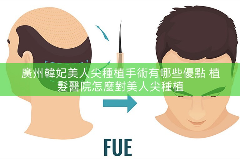 廣州韓妃美人尖種植手術有哪些優點 植髮醫院怎麼對美人尖種植