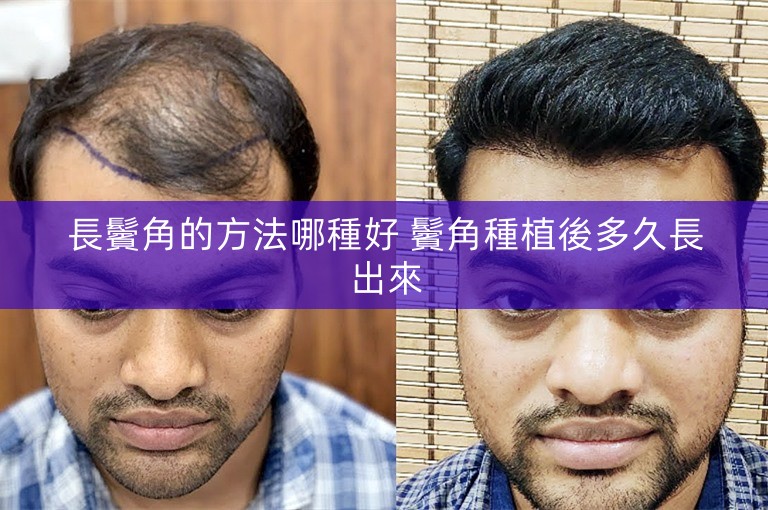 長鬢角的方法哪種好 鬢角種植後多久長出來