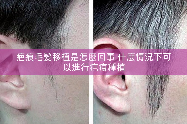疤痕毛髮移植是怎麼回事 什麼情況下可以進行疤痕種植
