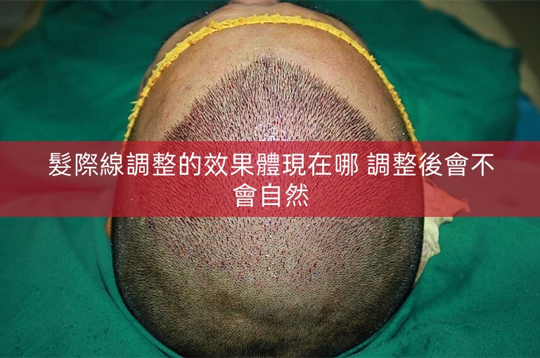 髮際線調整的效果體現在哪 調整後會不會自然 髮際線調整的效果體現在哪 調整後會不會自然