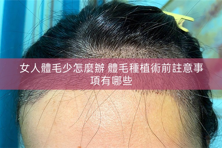 女人體毛少怎麼辦 體毛種植術前註意事項有哪些 女人體毛少怎麼辦 體毛種植術前註意事項有哪些