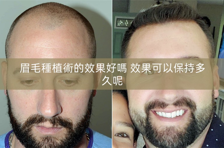 眉毛種植術的效果好嗎 效果可以保持多久呢