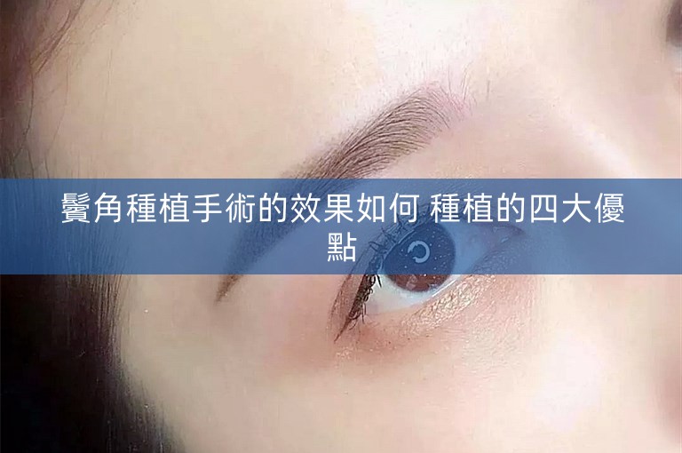 鬢角種植手術的效果如何 種植的四大優點