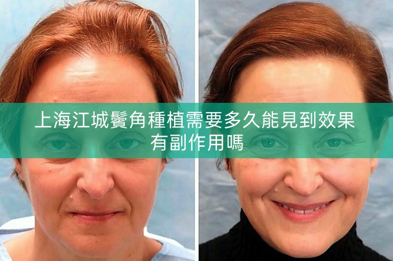 上海江城鬢角種植需要多久能見到效果 有副作用嗎
