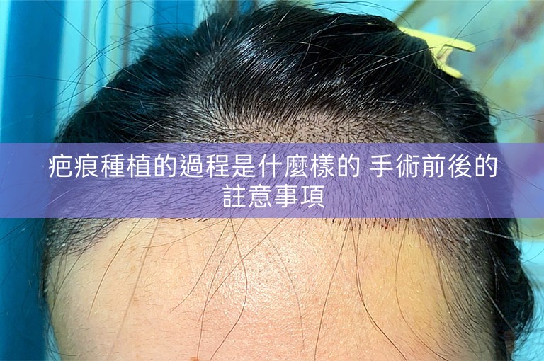 疤痕種植的過程是什麼樣的 手術前後的註意事項