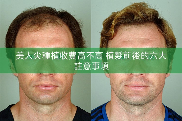 美人尖種植收費高不高 植髮前後的六大註意事項