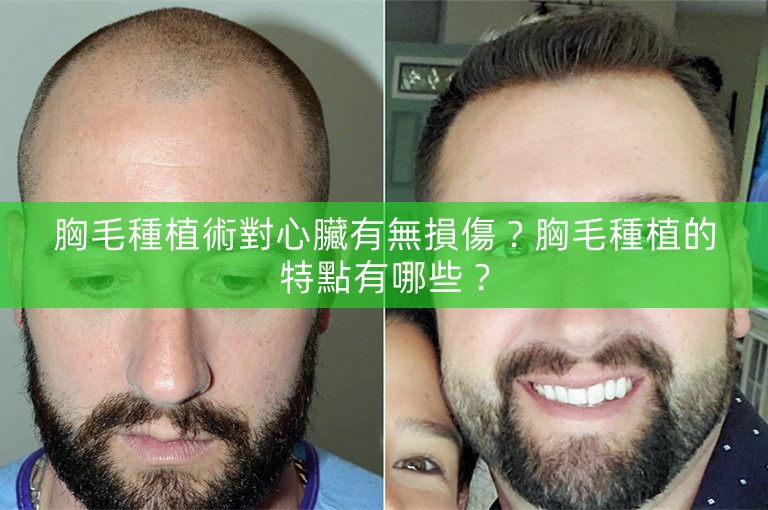 胸毛種植術對心臟有無損傷？胸毛種植的特點有哪些？