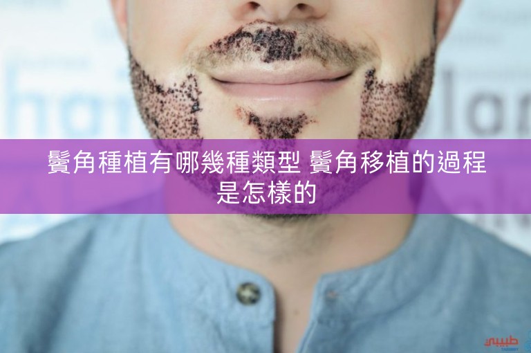 鬢角種植有哪幾種類型 鬢角移植的過程是怎樣的