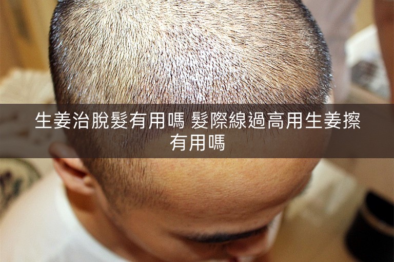 生姜治脫髮有用嗎 髮際線過高用生姜擦有用嗎