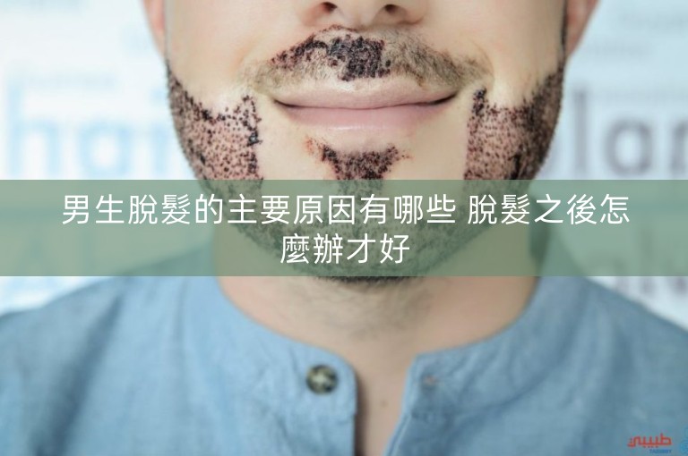 男生脫髮的主要原因有哪些 脫髮之後怎麼辦才好