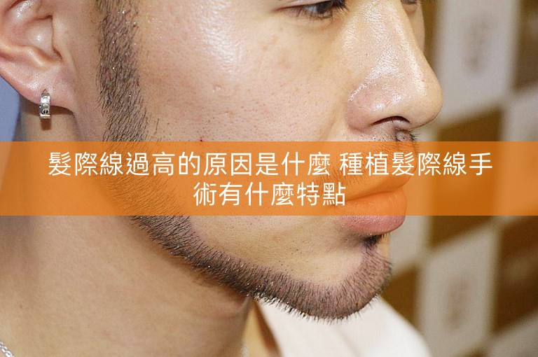 髮際線過高的原因是什麼 種植髮際線手術有什麼特點