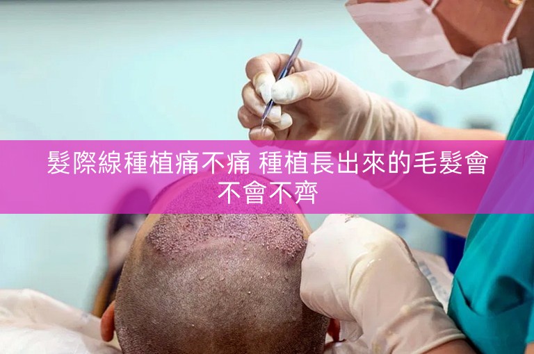 髮際線種植痛不痛 種植長出來的毛髮會不會不齊
