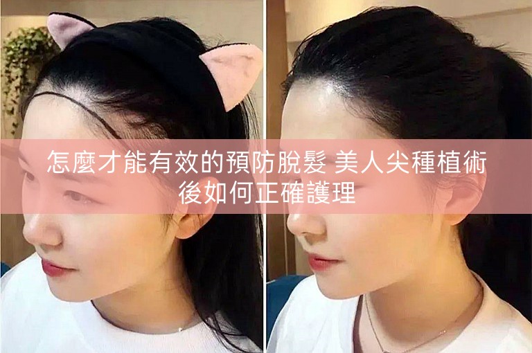 怎麼才能有效的預防脫髮 美人尖種植術後如何正確護理