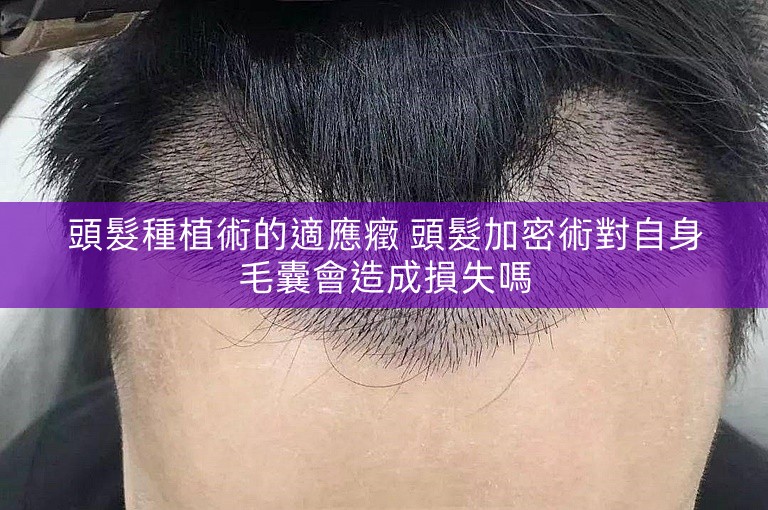 頭髮種植術的適應癥 頭髮加密術對自身毛囊會造成損失嗎