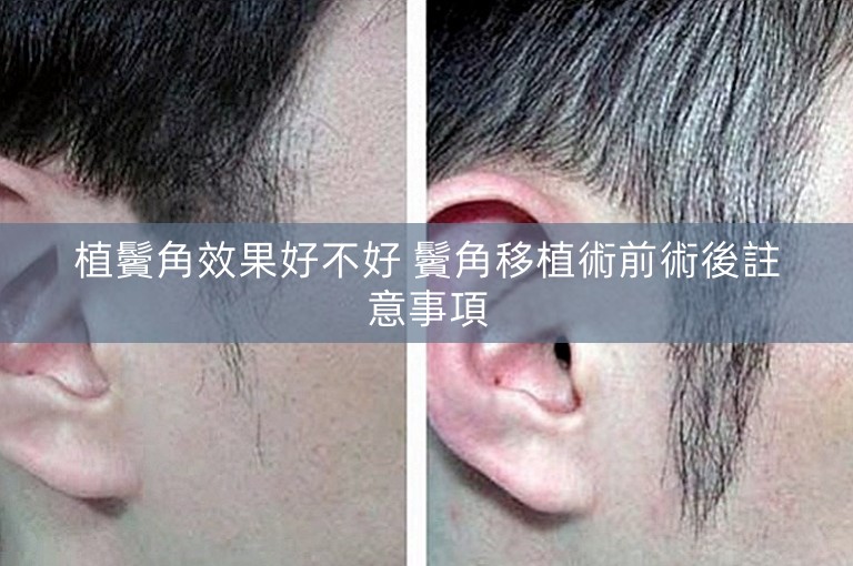 植鬢角效果好不好 鬢角移植術前術後註意事項