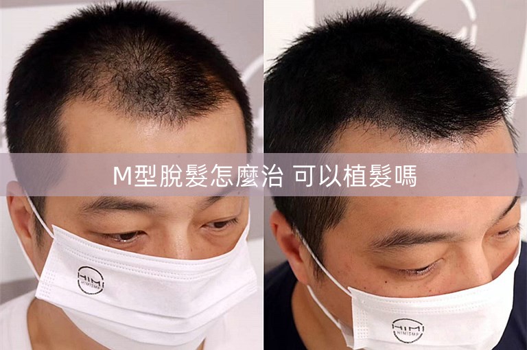 M型脫髮怎麼治 可以植髮嗎 M型脫髮怎麼治 可以植髮嗎