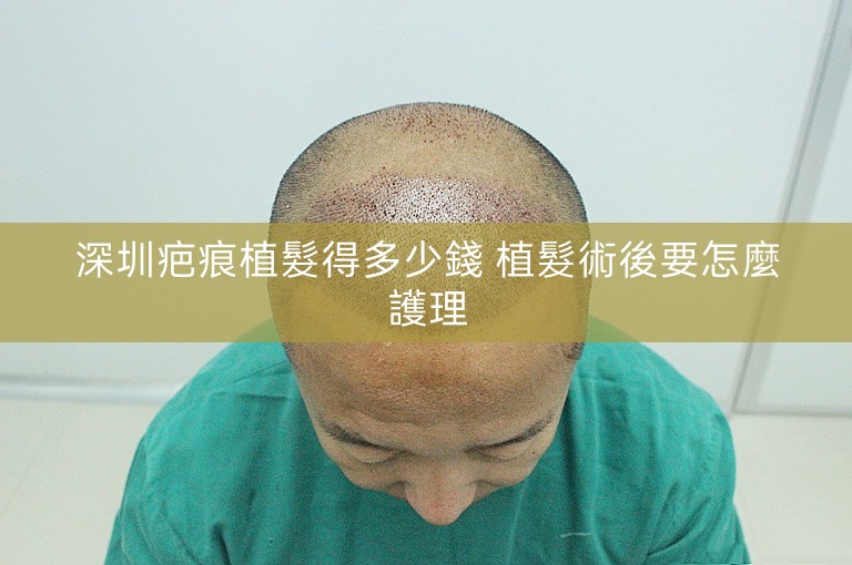 深圳疤痕植髮得多少錢 植髮術後要怎麼護理