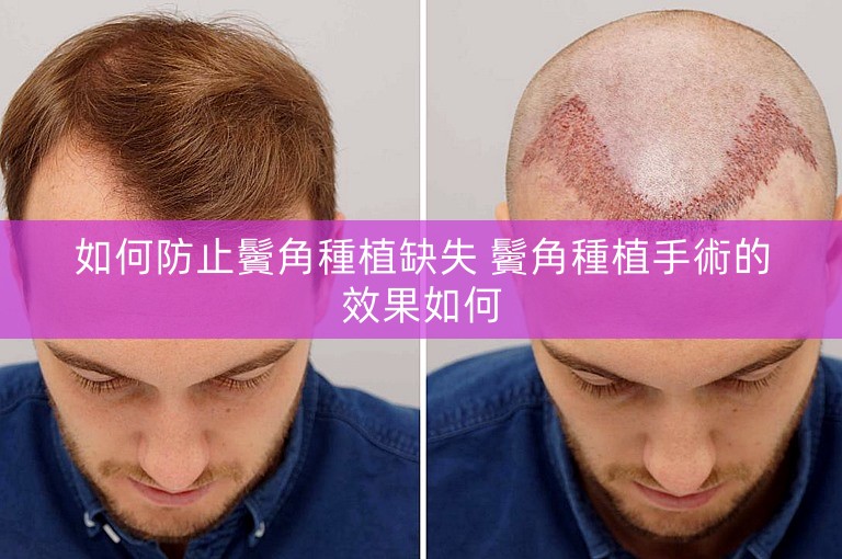 如何防止鬢角種植缺失 鬢角種植手術的效果如何