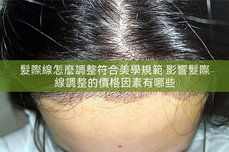 髮際線怎麼調整符合美學規範 影響髮際線調整的價格因素有哪些