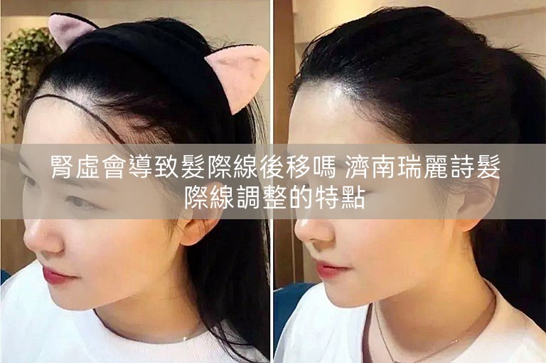 腎虛會導致髮際線後移嗎 濟南瑞麗詩髮際線調整的特點