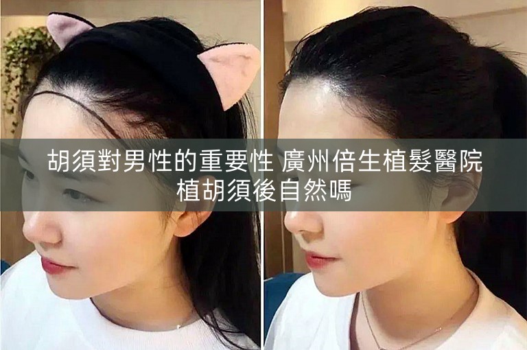 胡須對男性的重要性 廣州倍生植髮醫院植胡須後自然嗎