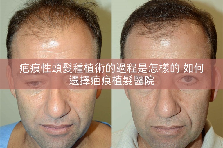 疤痕性頭髮種植術的過程是怎樣的 如何選擇疤痕植髮醫院
