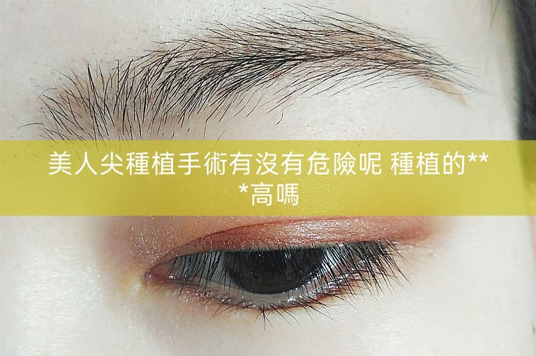 美人尖種植手術有沒有危險呢 種植的***高嗎 美人尖種植手術有沒有危險呢 種植的***高嗎