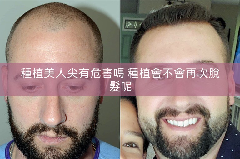 種植美人尖有危害嗎 種植會不會再次脫髮呢