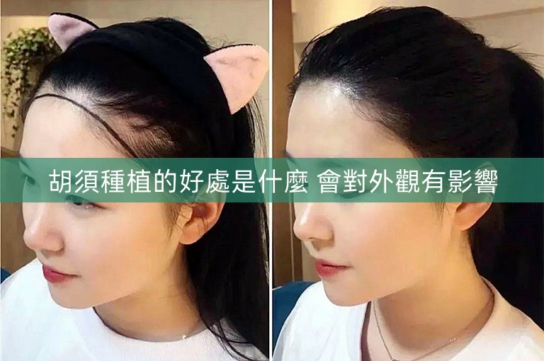 胡須種植的好處是什麼 會對外觀有影響