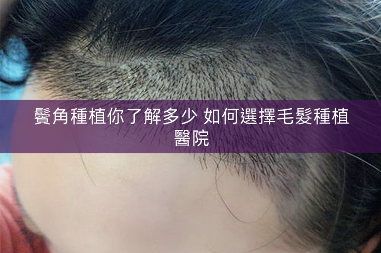 鬢角種植你了解多少 如何選擇毛髮種植醫院 鬢角種植你了解多少 如何選擇毛髮種植醫院