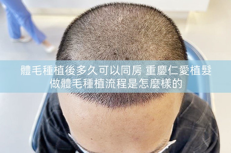 體毛種植後多久可以同房 重慶仁愛植髮做體毛種植流程是怎麼樣的
