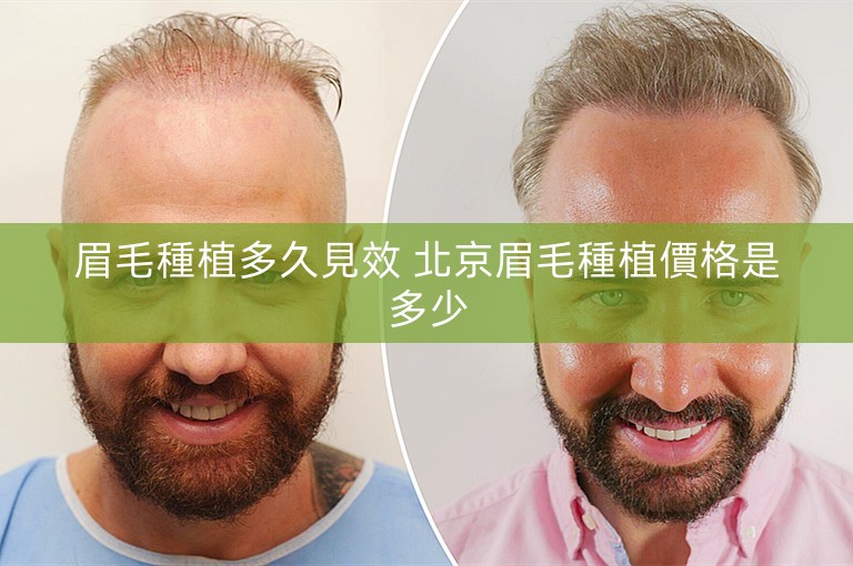 眉毛種植多久見效 北京眉毛種植價格是多少