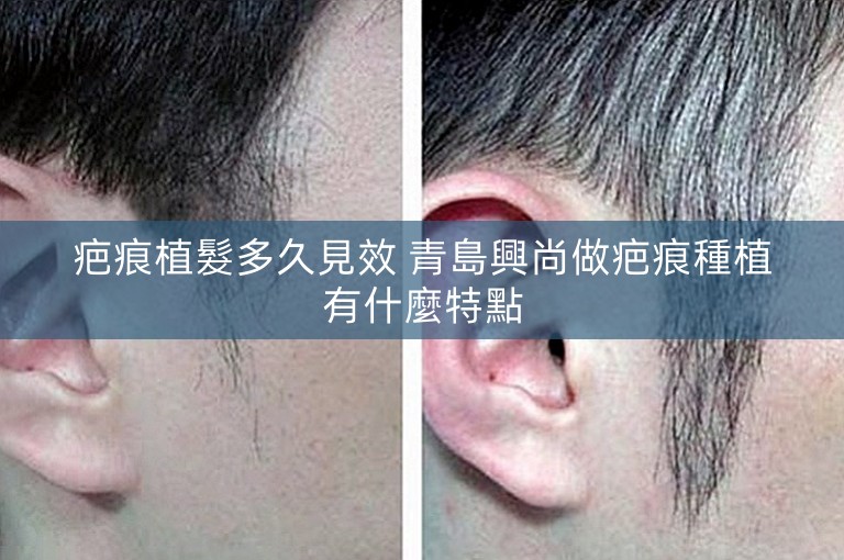 疤痕植髮多久見效 青島興尚做疤痕種植有什麼特點