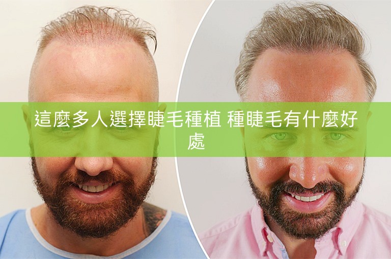 這麼多人選擇睫毛種植 種睫毛有什麼好處 這麼多人選擇睫毛種植 種睫毛有什麼好處