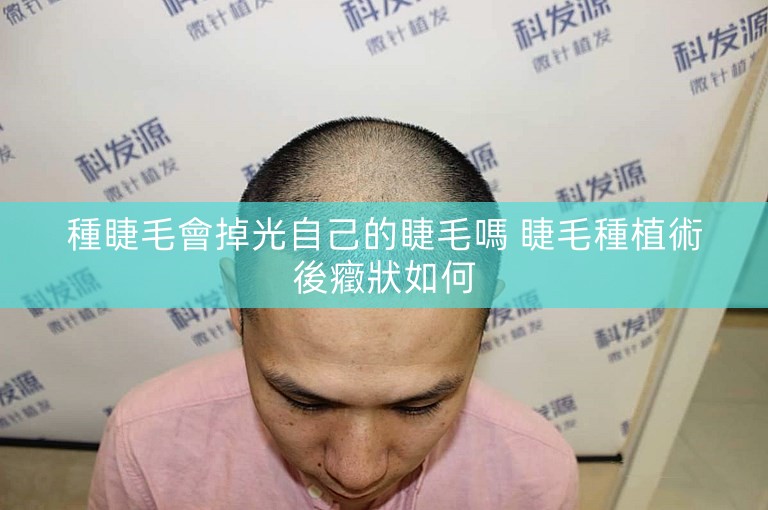 種睫毛會掉光自己的睫毛嗎 睫毛種植術後癥狀如何