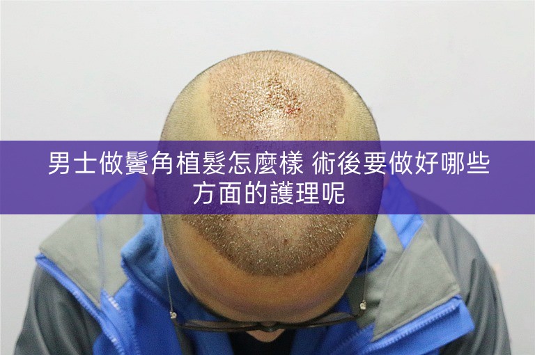 男士做鬢角植髮怎麼樣 術後要做好哪些方面的護理呢