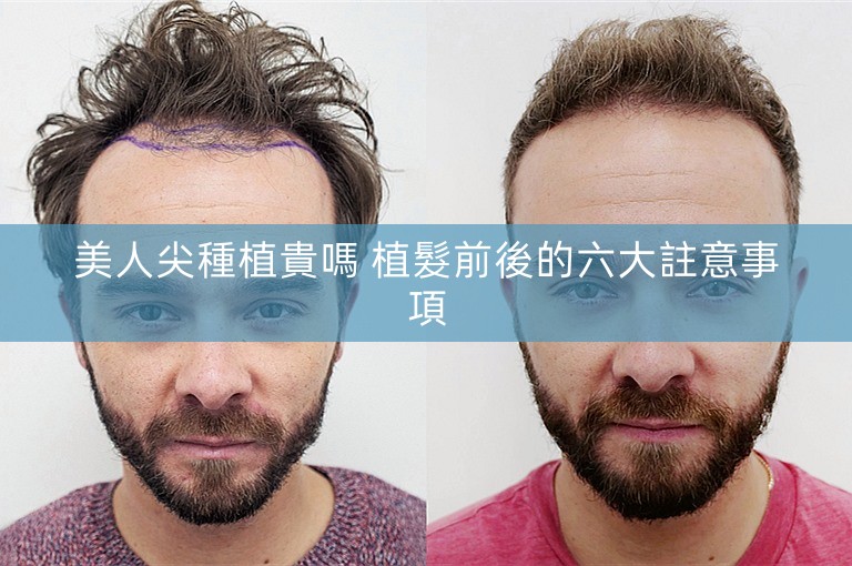美人尖種植貴嗎 植髮前後的六大註意事項