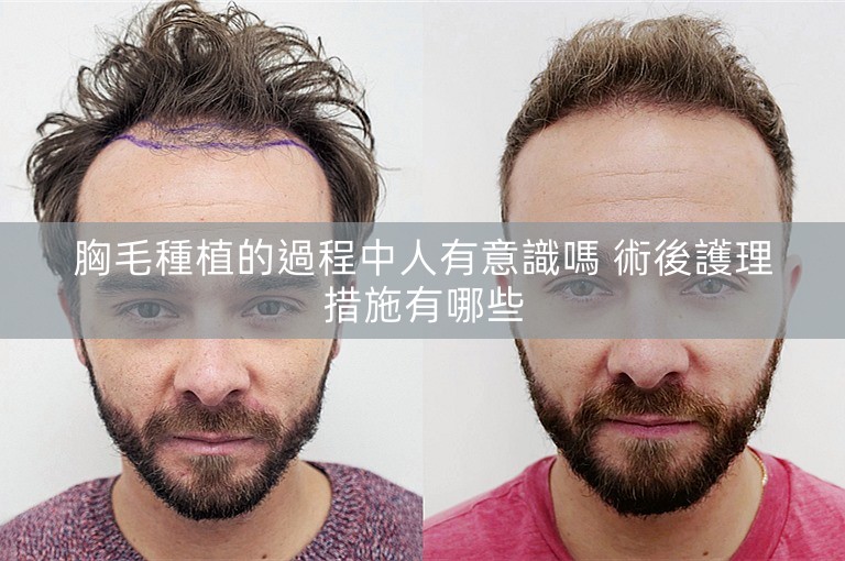 胸毛種植的過程中人有意識嗎 術後護理措施有哪些
