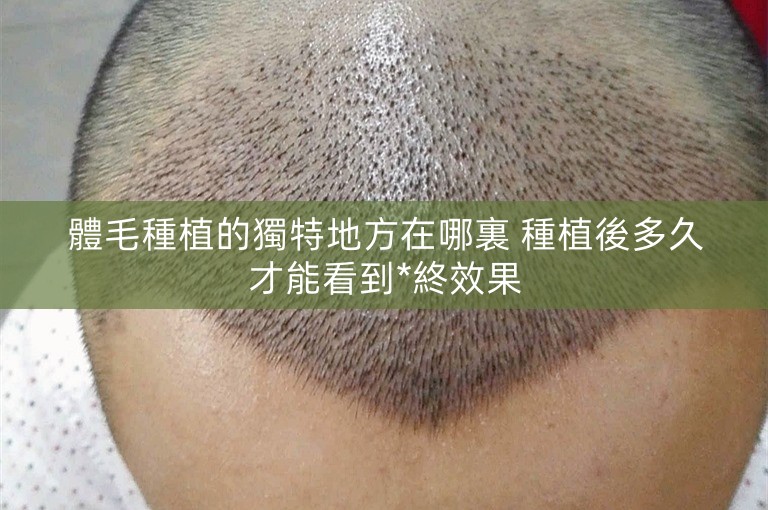 體毛種植的獨特地方在哪裏 種植後多久才能看到*終效果