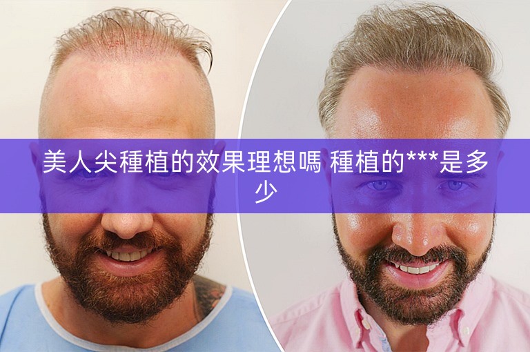 美人尖種植的效果理想嗎 種植的***是多少