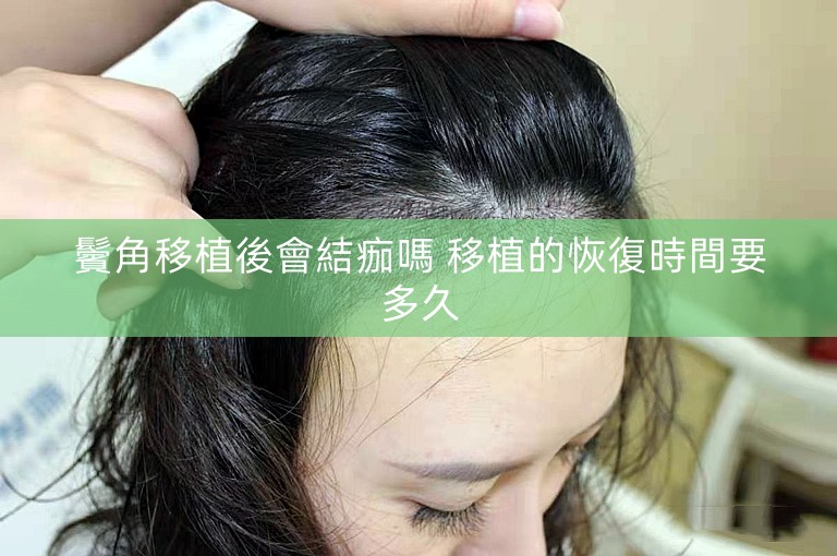 鬢角移植後會結痂嗎 移植的恢復時間要多久