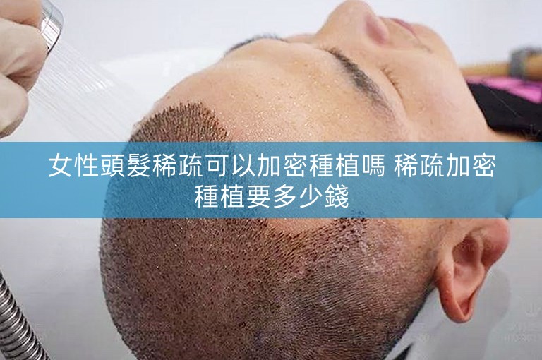 女性頭髮稀疏可以加密種植嗎 稀疏加密種植要多少錢
