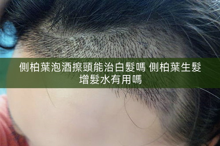 側柏葉泡酒擦頭能治白髮嗎 側柏葉生髮增髮水有用嗎