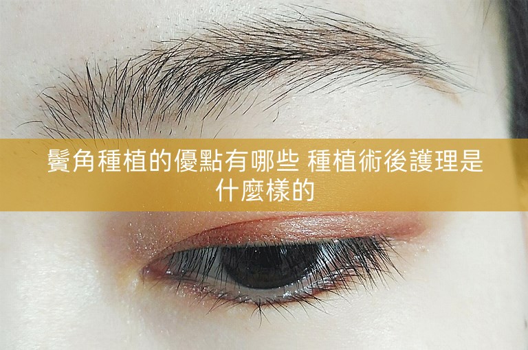 鬢角種植的優點有哪些 種植術後護理是什麼樣的