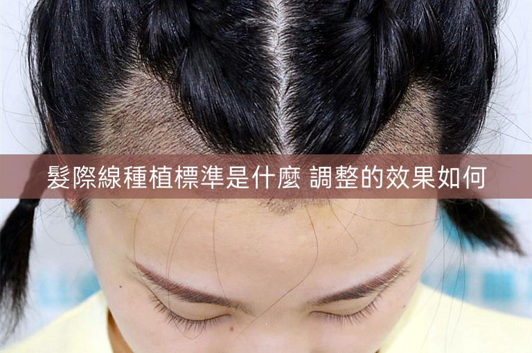 髮際線種植標準是什麼 調整的效果如何 髮際線種植標準是什麼 調整的效果如何