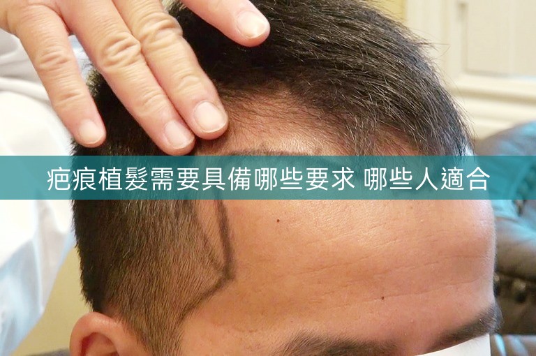 疤痕植髮需要具備哪些要求 哪些人適合 疤痕植髮需要具備哪些要求 哪些人適合
