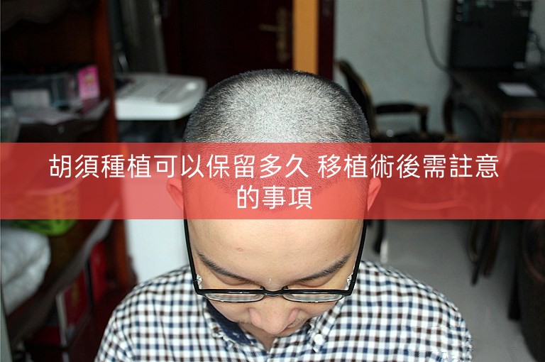 胡須種植可以保留多久 移植術後需註意的事項