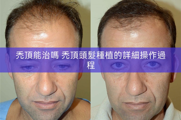 禿頂能治嗎 禿頂頭髮種植的詳細操作過程