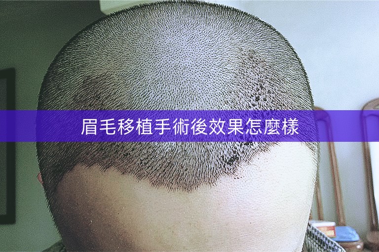 眉毛移植手術後效果怎麼樣