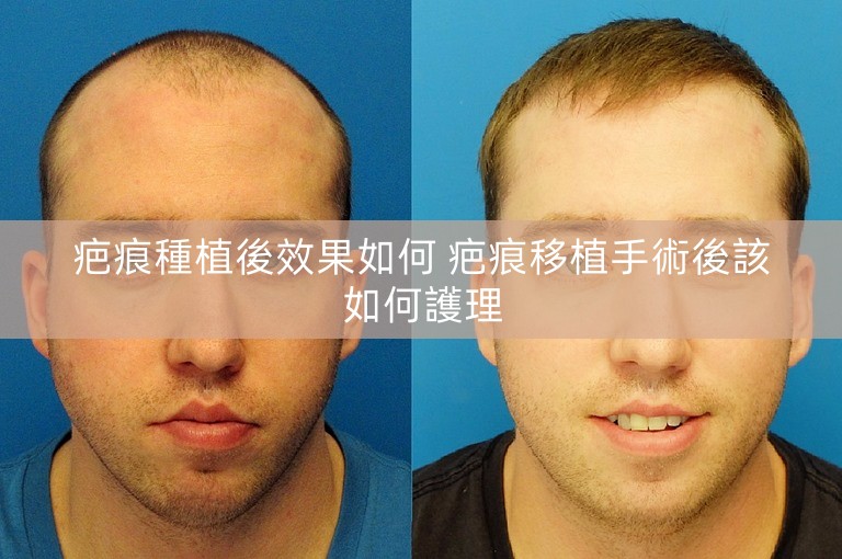 疤痕種植後效果如何 疤痕移植手術後該如何護理